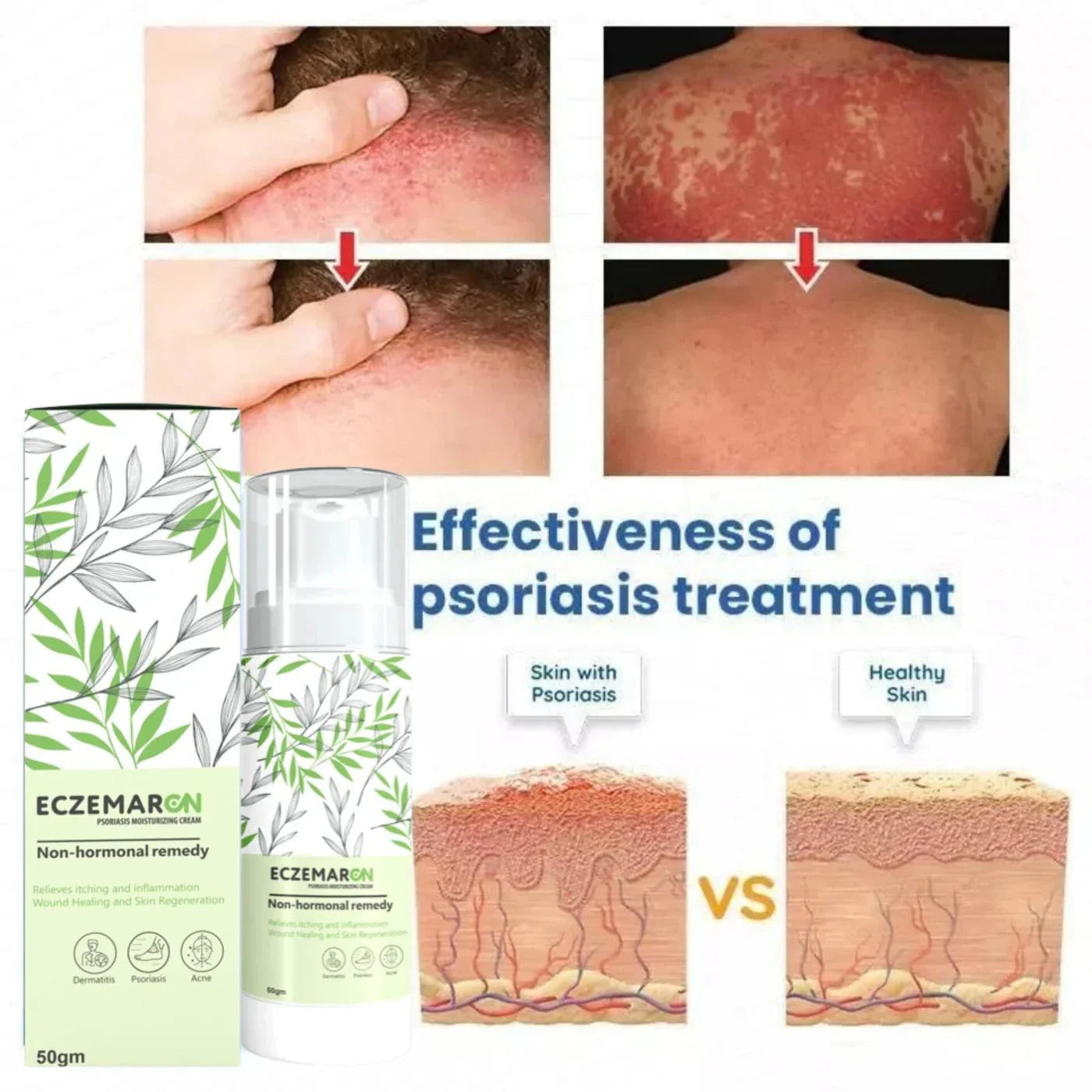 Eczemaron Anti Fungal Cream V Spray | Buy 1 Get 1 Free